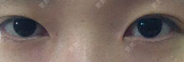 双眼皮