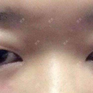 双眼皮