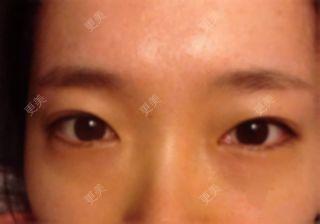 双眼皮