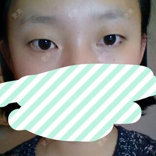 双眼皮