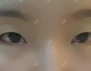 双眼皮
