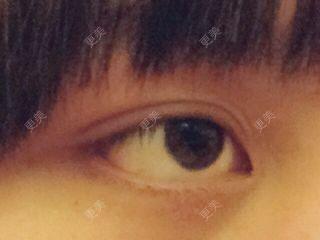 双眼皮