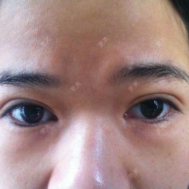 双眼皮