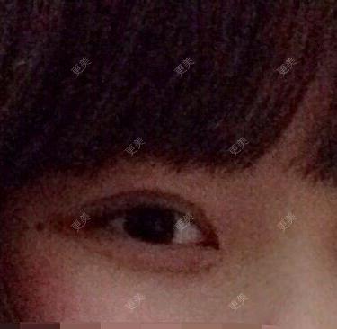 双眼皮