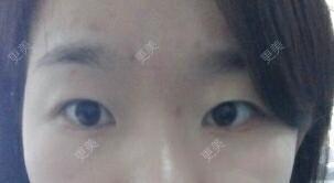 双眼皮