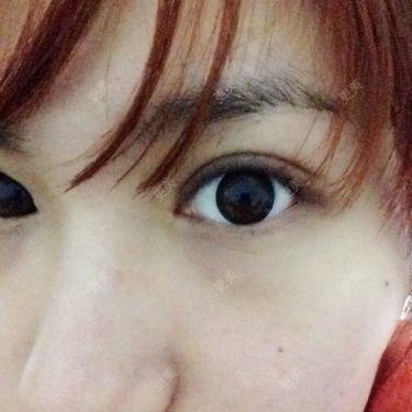 双眼皮