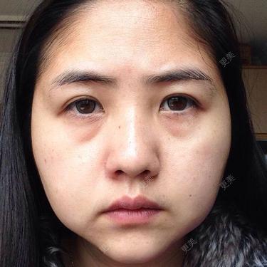 求问泪沟和黑眼圈的问题我泪沟的问题好像很严重如果填充泪沟黑眼圈跟