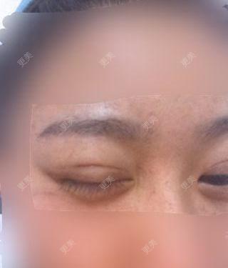 双眼皮