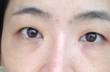 眼角下垂严重想开内眼角做双眼皮眼角下垂眼睛无神想再开内眼角做双