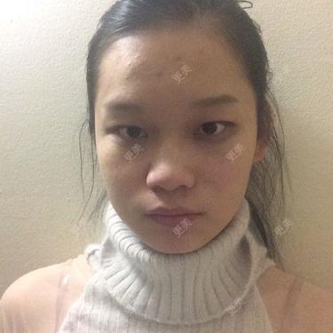 双眼皮