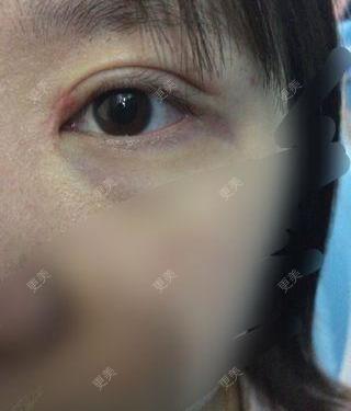 開眼角切開雙眼皮80天 眼角奇怪 感覺腫 多出來一塊 怎麼辦