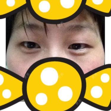 双眼皮