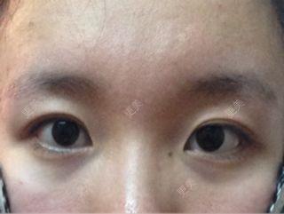 双眼皮