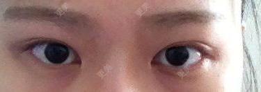 双眼皮
