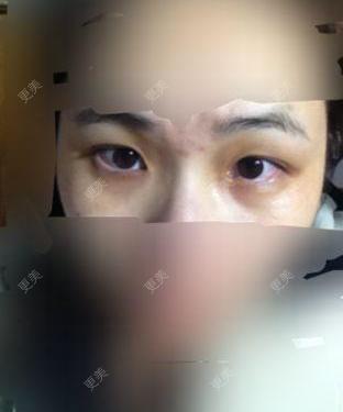 双眼皮