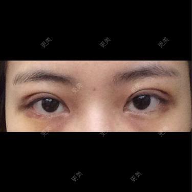 双眼皮
