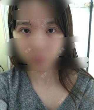 开眼角