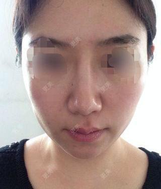 鼻形矫正