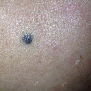 请问脸部这样的痣能去吗