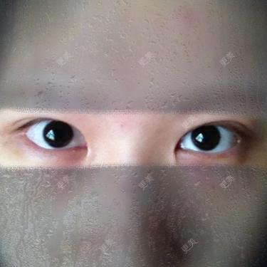 开眼角