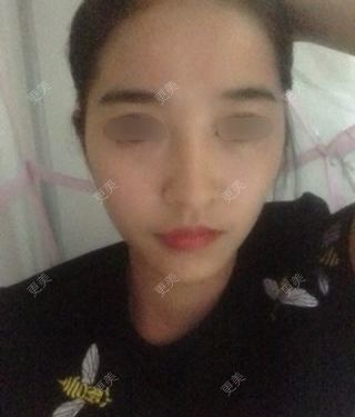 颧骨颧弓