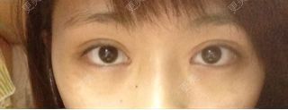 双眼皮