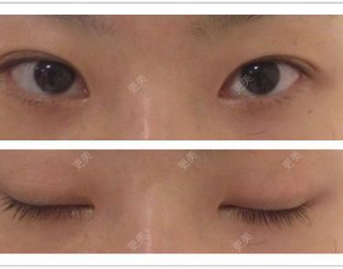 双眼皮