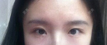 双眼皮