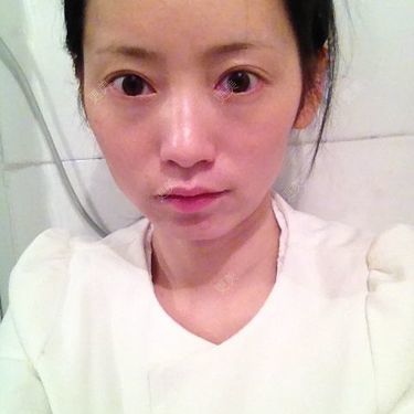 双眼皮