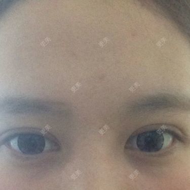 双眼皮