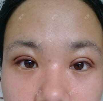 双眼皮