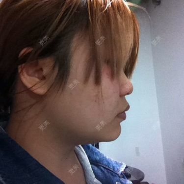 侧面下凹蒜鼻头第一次弄这个侧面不忍直视求意见