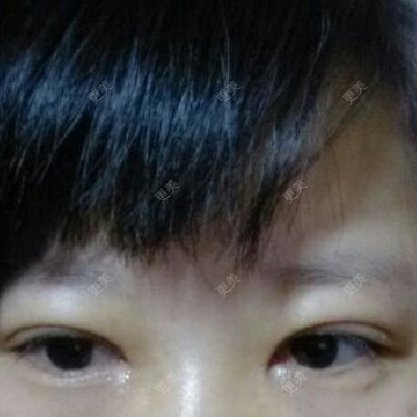双眼皮