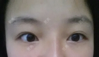 双眼皮