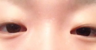 双眼皮