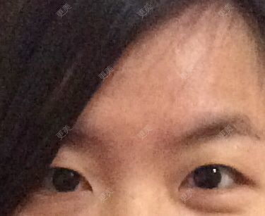 双眼皮