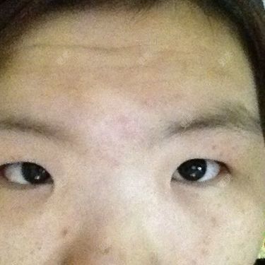 双眼皮