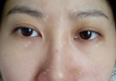 双眼皮
