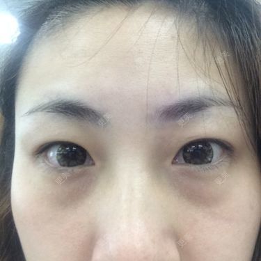 双眼皮