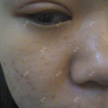 双眼皮
