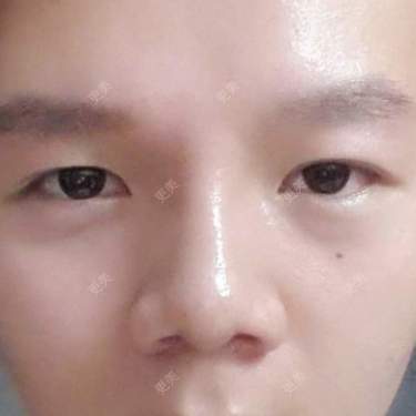 双眼皮
