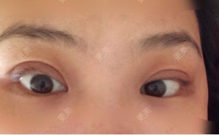 双眼皮