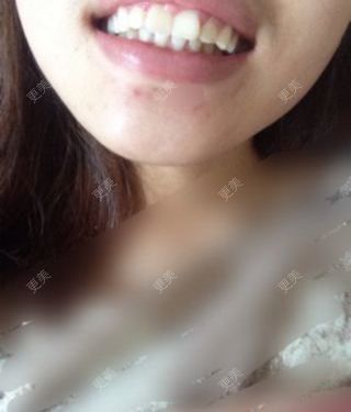 牙齿整形