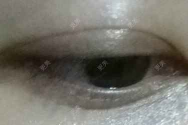 双眼皮