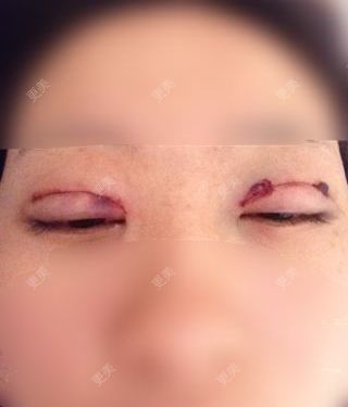 双眼皮