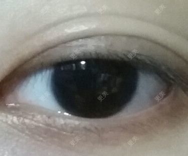 双眼皮