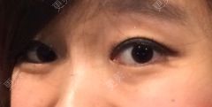 双眼皮