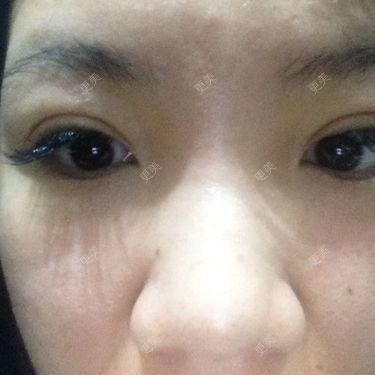 双眼皮