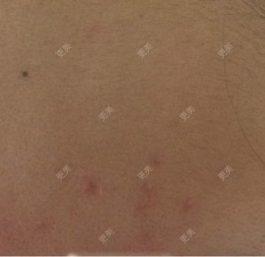 祛疤痕痘印