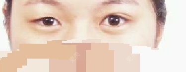 双眼皮